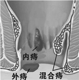 外痔应该怎么治疗好