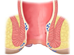 外痔的临床表现是什么